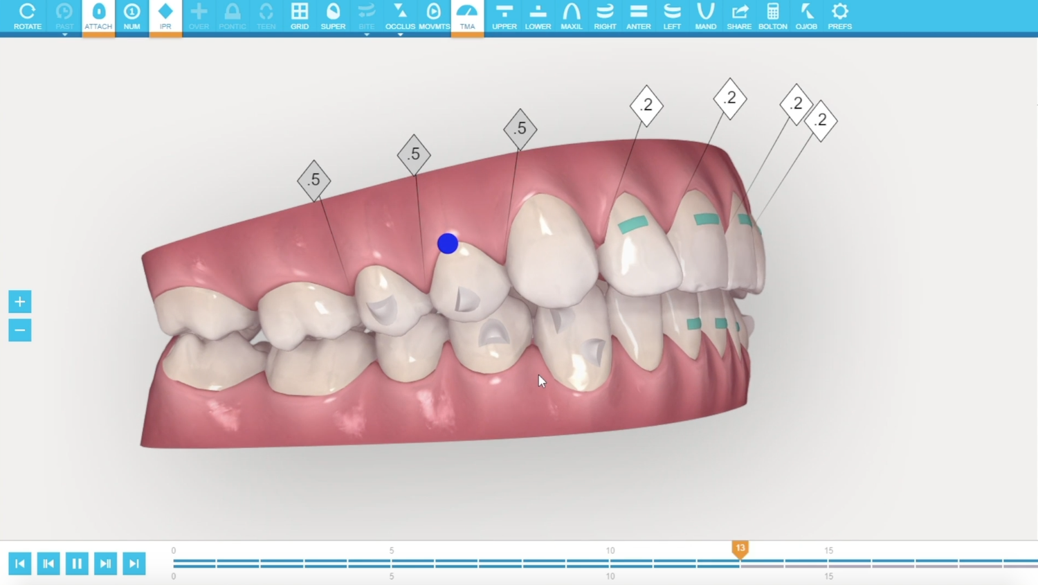 Invisalign clincheck scan